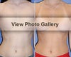 Breast Augmentation before & after photos