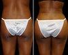 Butt augmentation before & after photos