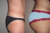 Butt implants before & after photos