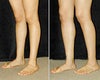 Calf implant before & after photos