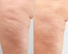 Cellulite treatment before & after photos