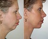 Chin implant before & after photos