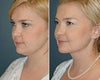Chin liposuction before & after photos