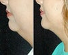 Chin surgery before & after photos