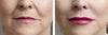 Collagen injection before & after photos