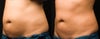 Cool Lipo before & after photos