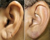 Ear lobe surgery before & after photos