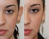 Ear surgery before & after photos