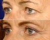 Eyelid Surgery before & after photos