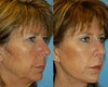 Facelift before & after photos