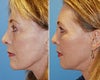 Fat transfer before & after photos