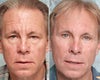 Forehead lift before & after photos