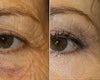 Fraxel Laser before & after photos