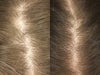 Hair Loss Treatment before & after photos