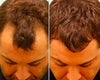 Hair transplant before & after photos