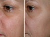 IPL before & after photos