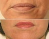Juvederm before & after photos