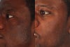 Laser Genesis before & after photos