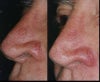 Laser resurfacing before & after photos
