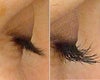 Latisse before & after photos