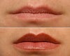 Lip augmentation before & after photos