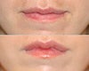 Lip lift before & after photos
