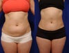 Liposculpture before & after photos