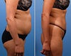 Liposuction before & after photos