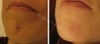 Lux 1540 before & after photos