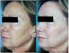 MiXto Laser before & after photos