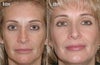 Microdermabrasion before & after photos