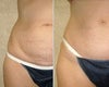 Mini tummy tuck before & after photos