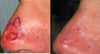 Mohs surgery before & after photos