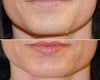 Mole removal before & after photos