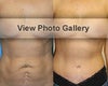 Mommy makeover before & after photos