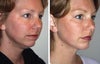 Neck lift before & after photos
