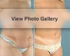 Nipple surgery before & after photos