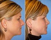 Nose surgery before & after photos