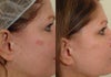 Pearl laser before & after photos