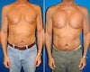 Pec implants before & after photos