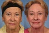 Phenol peel before & after photos