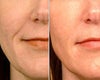 Radiesse before & after photos