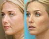 Restylane before & after photos