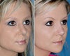 Revision rhinoplasty before & after photos
