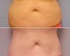 Slim Lipo before & after photos