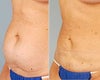 Smart Lipo before & after photos