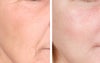 TCA peel before & after photos