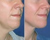 Thermage before & after photos