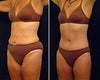 Tummy tuck before & after photos