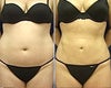Vaser Liposuction before & after photos